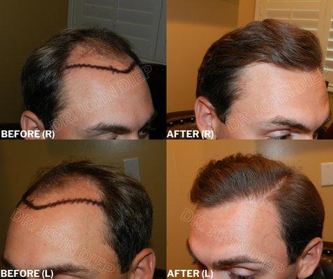 MENS FRONTAL HAIR LOSS BEFORE AND AFTER PHOTOS