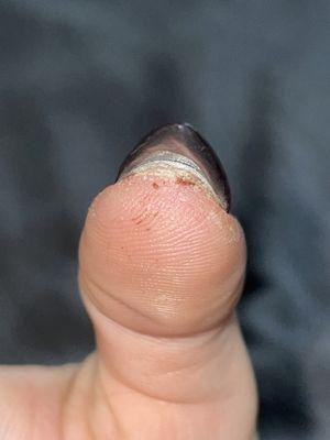 This is the thumb she had drilled