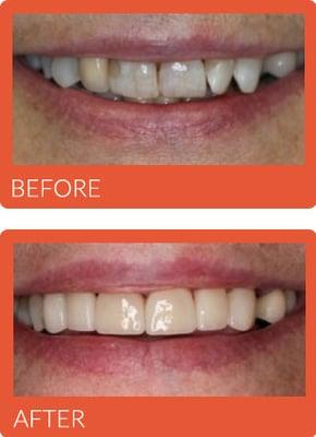 Before and After Photos - Alpine Meadows Family Dental in Lehi http://www.alpinemeadowsfamilydental.com/our-office