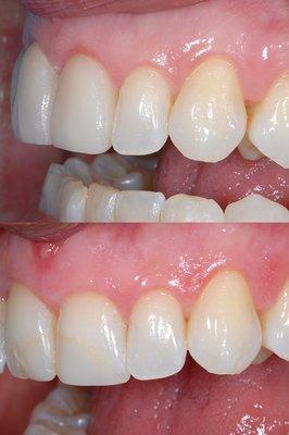 Veneers that look natural!