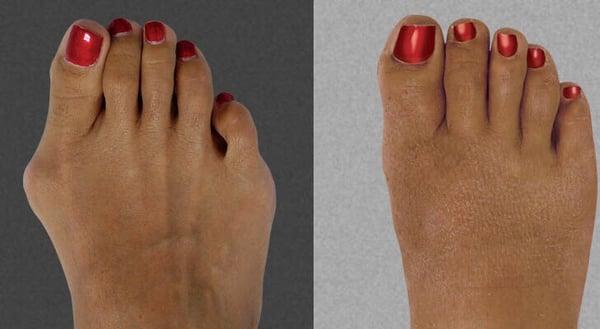 Bunion surgery, as well as other corrective surgeries are offered by our Board Certified Podiatrists