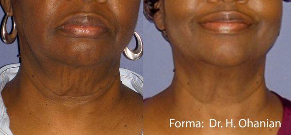 Forma skin tightening treatment