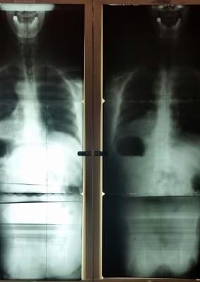 4 years ago this patient started care and today he is growing better (left is before-right is currently)  Imagine if he had h...