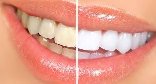 Whitening Procedures