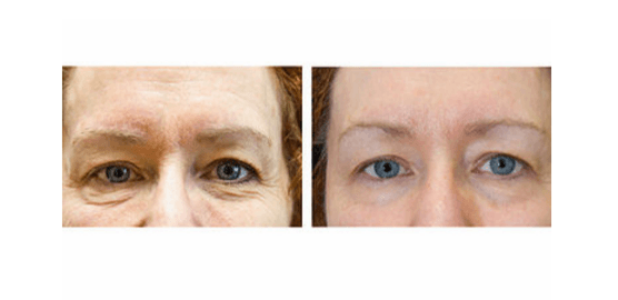 NON SURGICAL EXILIS EYE REJUVENATION