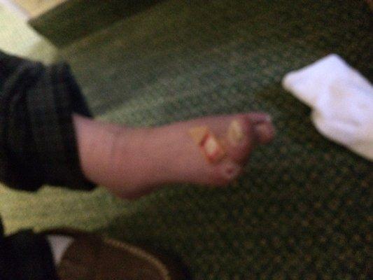 An open sore I noticed on his foot that had bleed through his sock