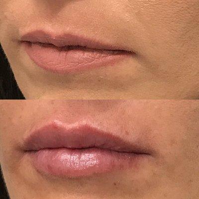 Soft, natural-looking lips are achieved with Restylane Refyne.  This is before and immediately after lip injections by Jeremy Romaine, PA-C.