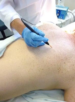 Dr. Gillaspie using the Ellman Surgitron to remove moles on a patient's back.