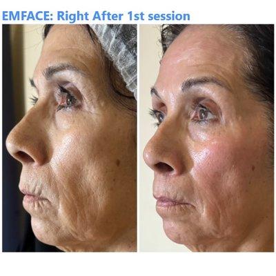 Result from the first session of EMFACE face lift treatment (right after the treatment)