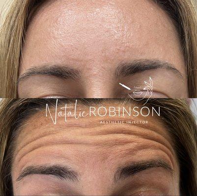 Xeomin Wrinkle Treatment