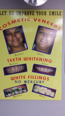 whitening available