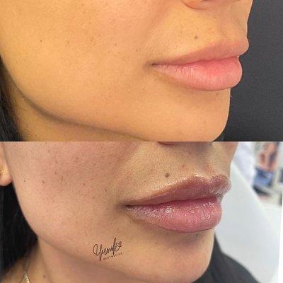 Plumpy Pout for this Babe!  Treatment: Lip Filler Purpose: hydrate lips, restore volume loss, correct asymmetry. Cost: 500-700