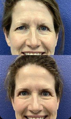 This nice patient underwent upper eyelid blepharoplasty by Dr. Iyengar in our office.