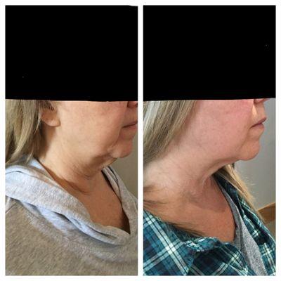 Ultherapy Skin Tightening and Kybella Fat Dissolving