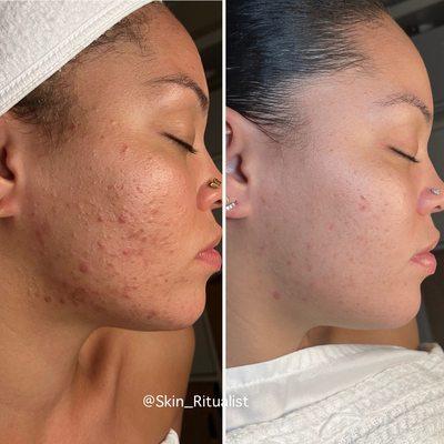 Before and after chemical peel series at Skin Ritualist, Esthetician in Hollywood, FL