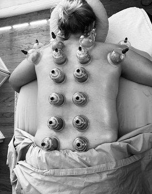 Cupping therapy