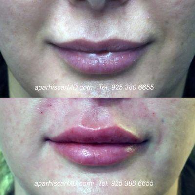 Fuller natural lips