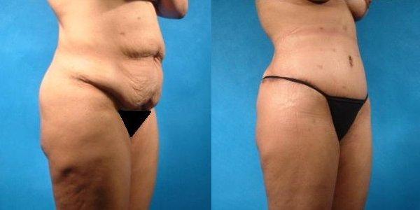 Tummy Tuck and leg tightening by Dr LoMonaco