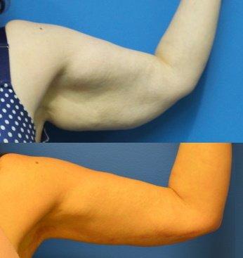 Brachioplasty (arm lift).  Notice the well-healed scar in the ideal location.