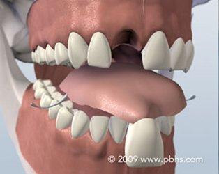 Dental Implant Sarasota, FL