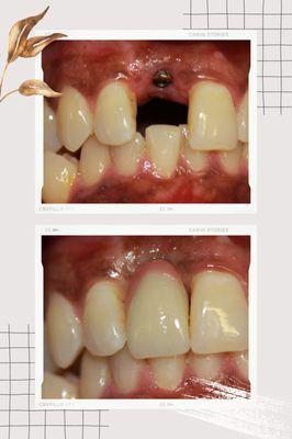 Front tooth implant.