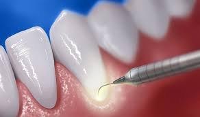 Laser dentistry means no shots and no drills for most patients.