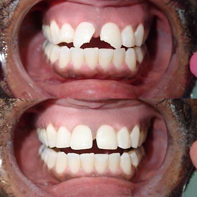 Before and after of teeth reconstruction