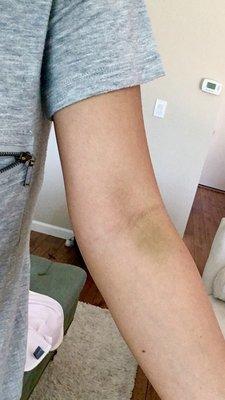 Arm bruised and in pain for a week and counting after blood draw. Not prone to bruising.