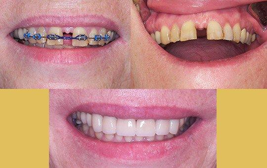 Anterior Veneers