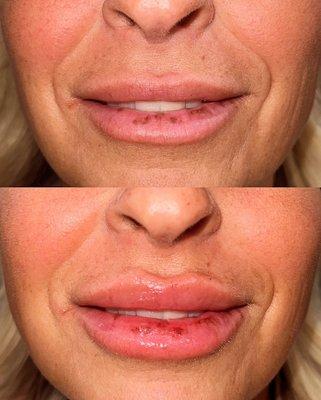 Lip filler