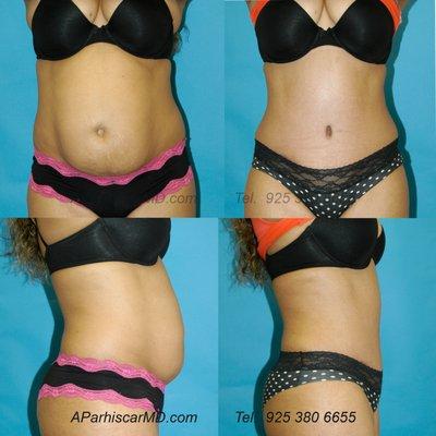 Tummy tuck for a flatter tummy and narrower waist