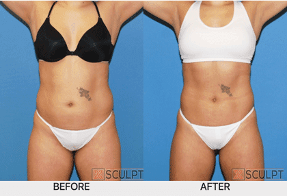 XSculpt Body Transformation Patient: SculpSure Laser Fat Reduction, Bioidentical Hormone Therapy, MK, Personal Training