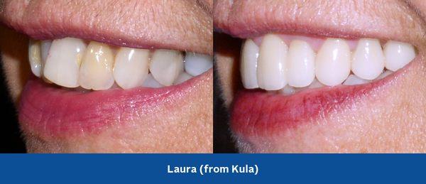 Instead of spending years in braces, Laura was restored with veneers and crowns to "straighten" her teeth WITHOUT orthodontic treatment!