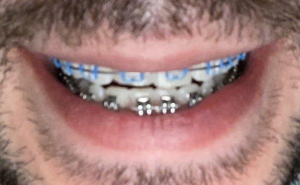 Diamond Braces