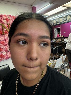 Swelling in the brows due to unexperienced worker.