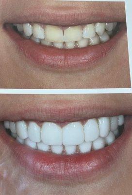 Porcelain ultra-thin no-prep veneers