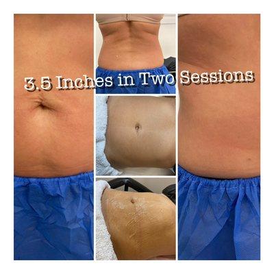 Ultrasonic Cavitation