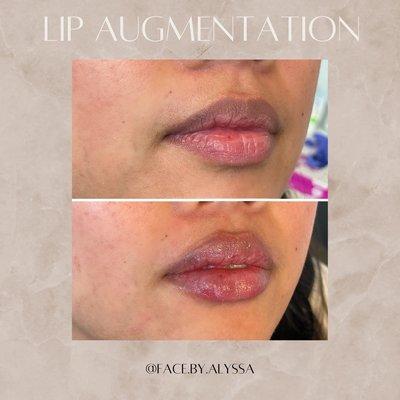 Lip augmentation by Nurse Alyssa