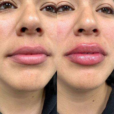 Lip Filler