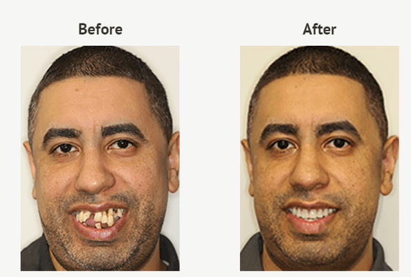 Dental Implant Restoration