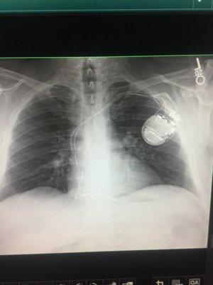 After defibrillator implant