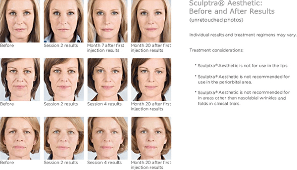 #Sculptra B&A gradual effect 
full face volumization