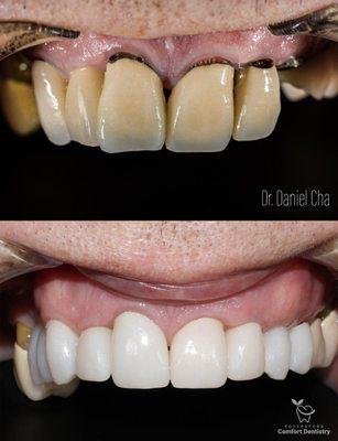 Before and after showing different treatments offered by Royersford Comfort Dentistry. Restoration with crowns and implants.