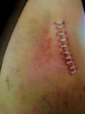 This is the incision site from my surgery that I had on Monday I'm in severe pain it doesn't look good what should I do????