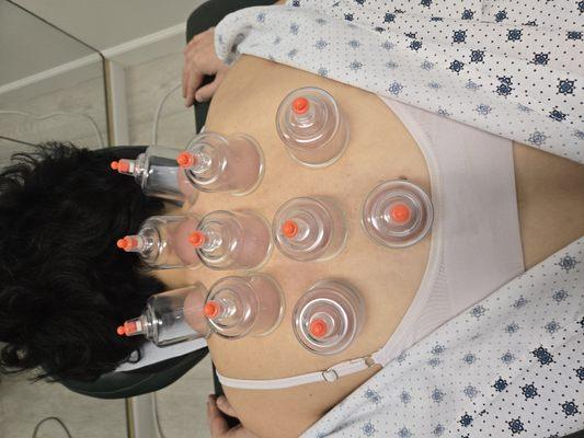 Cupping