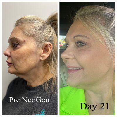 Neogen Client after 3 weeks.  Great improvement of skin tone, color and smoothness