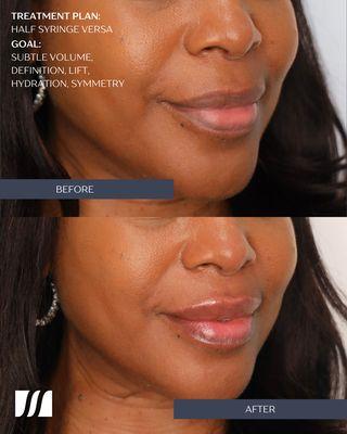 Our patient wanted subtle volume, definition and hydration. We were able to achieve these results with a half syringe of lip filler.