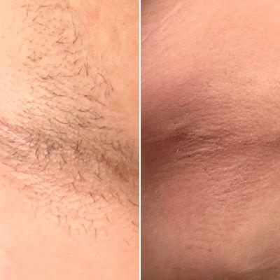 Before/After underarm waxing