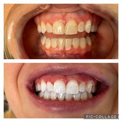 Teeth Whitening Metairie  La