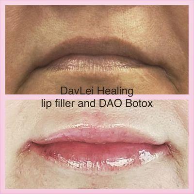 Lip flip with Botox